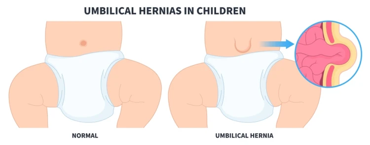 الفتق الاربي عند البنات