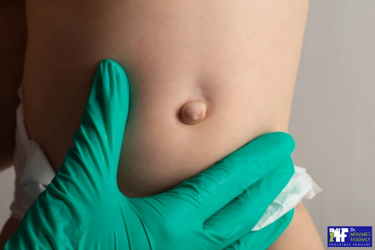 الفتق الاربي الفتق الاربي