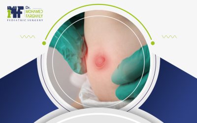 تعرف على طرق علاج فتق السرة بدون جراحة عند الرضع