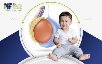 تخلص من القيلة المائية نهائيًا: خطوات العلاج ونصائح ما بعد العملية