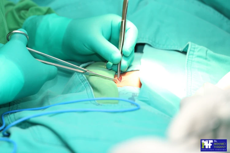 تجربتي مع عملية الفتق الإربيلإربي