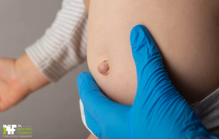 علاج الفتق السري عند الأطفال