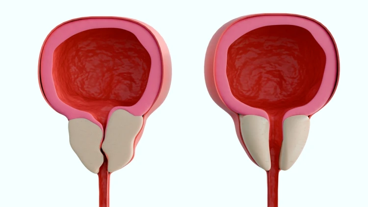 عملية الإحليل السفلي للاطفال