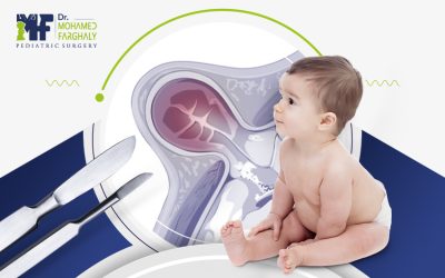 عملية فتق اربي: تجنب المضاعفات وعُد لحياتك الطبيعية بسرعة