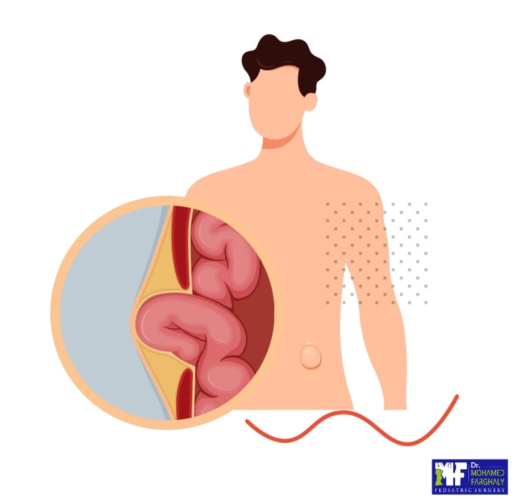 عملية فتق اربي