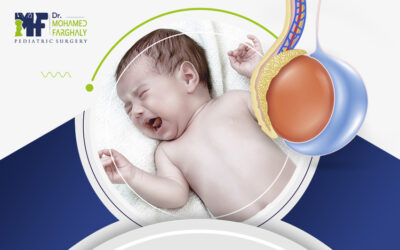 هل تستدعي القيلة المائية عند الرضع الخوف؟