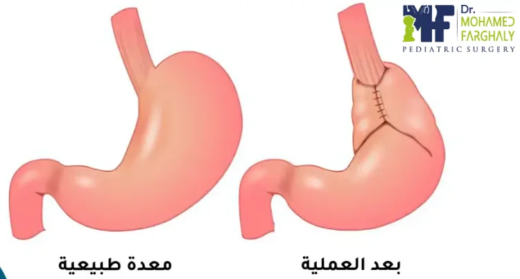 تجربتي مع عملية فتق الحجاب الحاجز