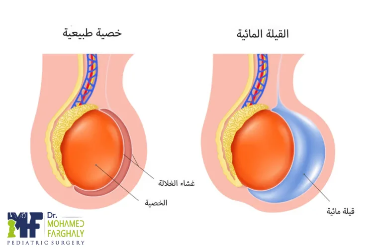كيف تتكون القيلة المائية عند الرضع؟