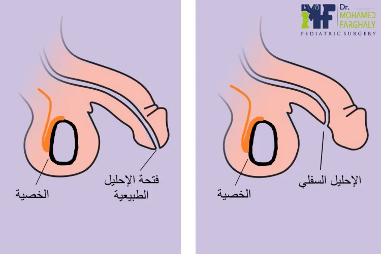 ما أسباب الاحليل البولي المرتجع؟