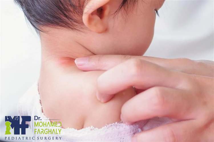 ما أسباب مرض الناسور عند الاطفال في الرقبة؟