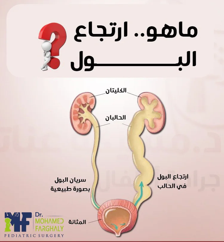 ما تأثير ارتجاع البول على الكلى عند الاطفال