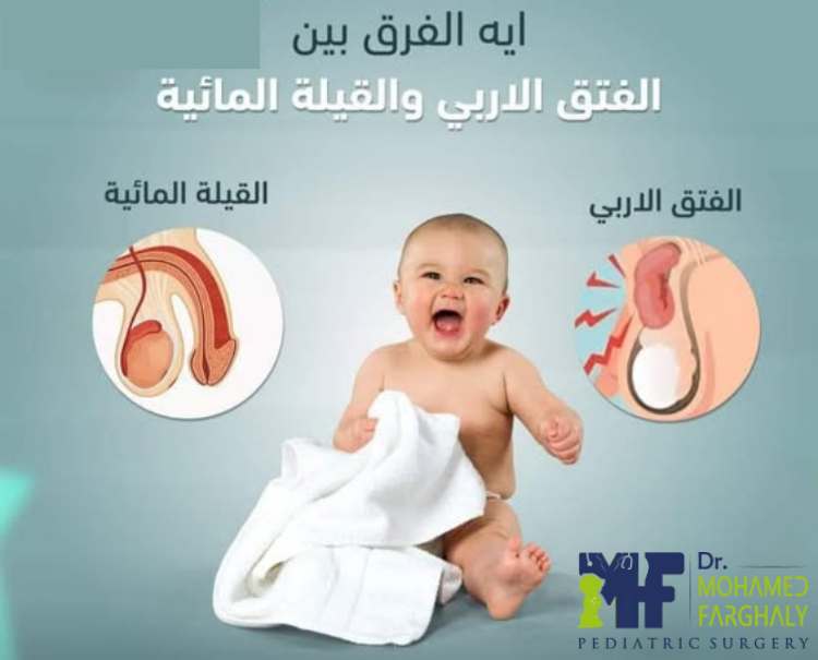 ما هو الفرق بين القيلة المائية والفتق الإربي؟