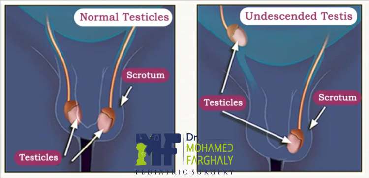 شكل الخصية المعلقة بعد العملية