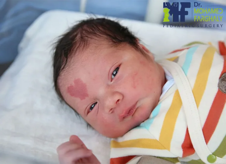 علاج الوحمة الدموية للرضع