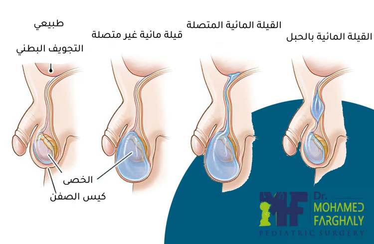 ما أفضل علاج للقيلة المائية عند الأطفال؟