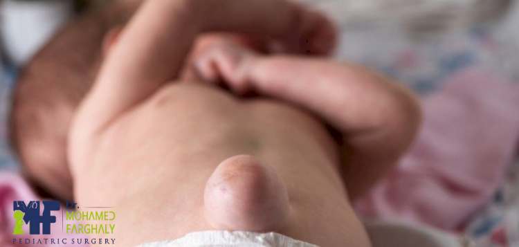 أنواع الفتق السري عند الأطفال بالصور