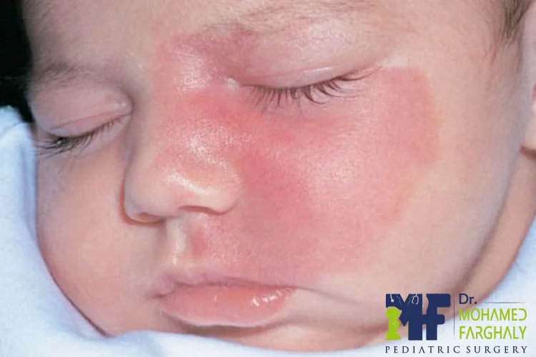 ما هي الوحمة الدموية