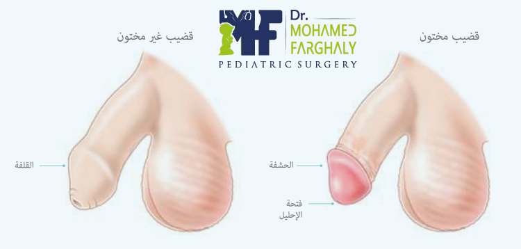 ما هي عملية تصحيح الطهارة للأطفال؟