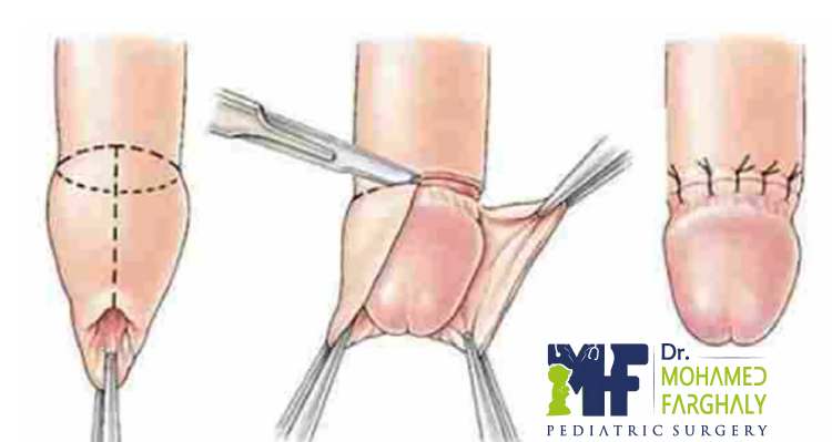 متى يجب إعادة الختان بالصور