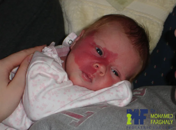 متى يلجأ الطبيب إلى علاج الوحمة الدموية جراحيًا؟