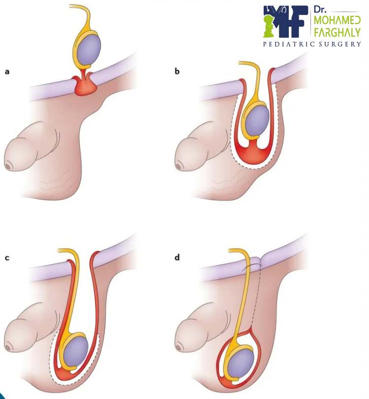 نبذة حول عملية الخصية المعلقة