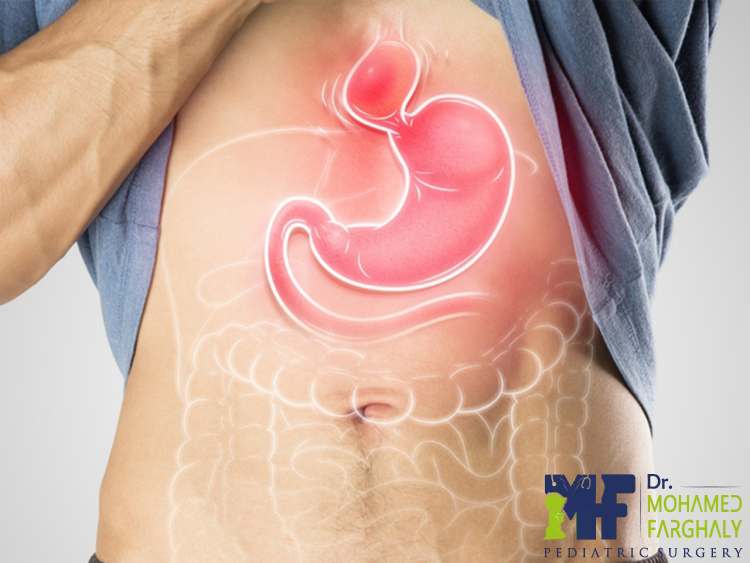 ما هو فتق الحجاب الحاجز؟