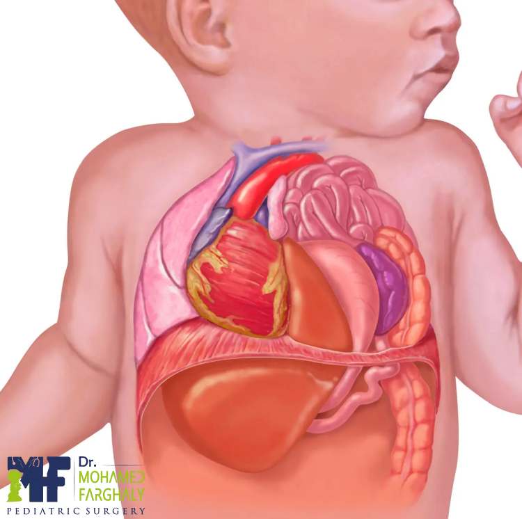 هل يمكن الوقاية من اسباب فتق الحجاب الحاجز؟