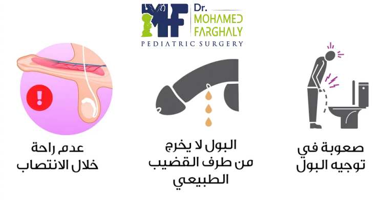 تسرب البول بعد عملية الإحليل التحتي