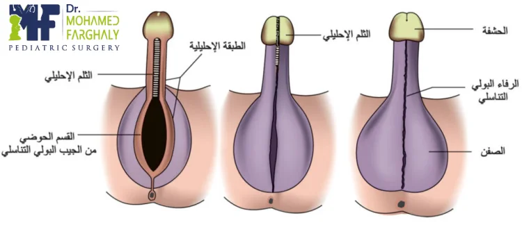 ما المشكلات التي قد تظهر على الأطفال بسبب الاحليل السفلي؟