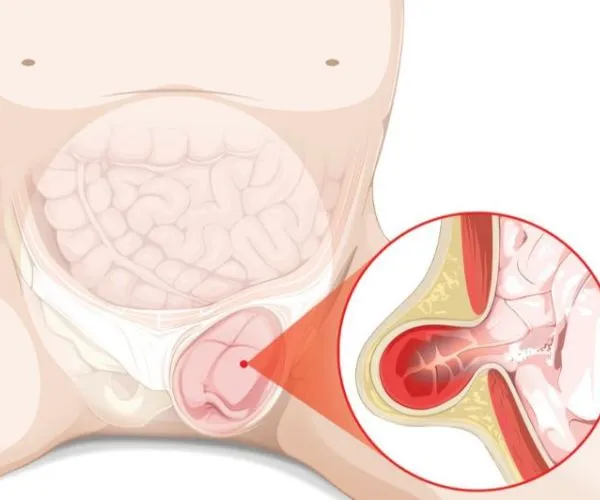 تورم الخصية بعد عملية الفتق الاربي تورم الخصية بعد عملية الفتق الاربي