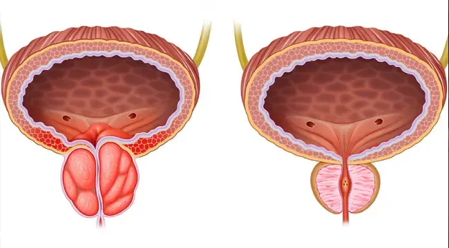 توسيع مجرى البول