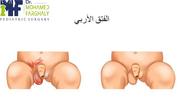 أعراض الفتق عند الأطفال الذكور
