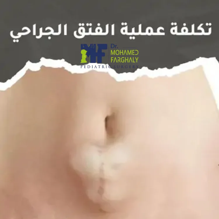 تكلفة عملية الفتاق في مصر