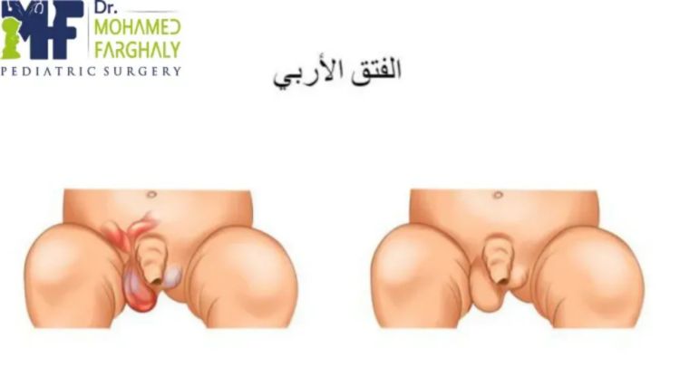 الفتق-عند-الأطفال