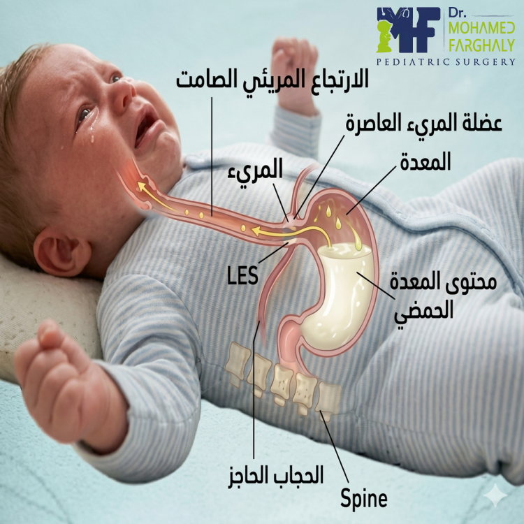 ما هو الارتجاع الصامت؟ (ولماذا لا يتقيأ الطفل؟)